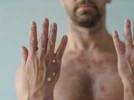 Male hands affected by blistering rash because of monkeypox or other viral infection on white background