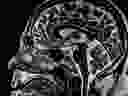 MRI image brain