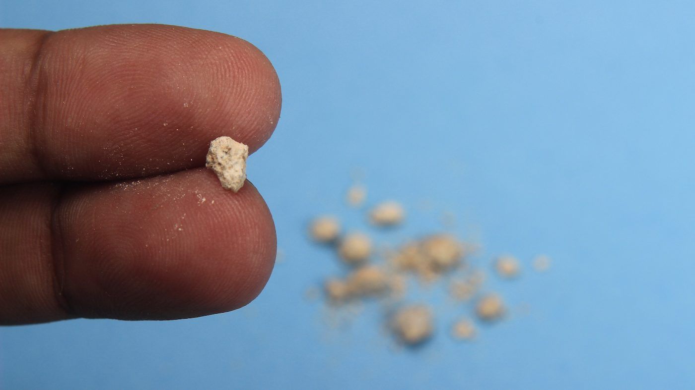 According to the Kidney Foundation, kidney stones are not only common in Canada, they’re on the rise. GETTY