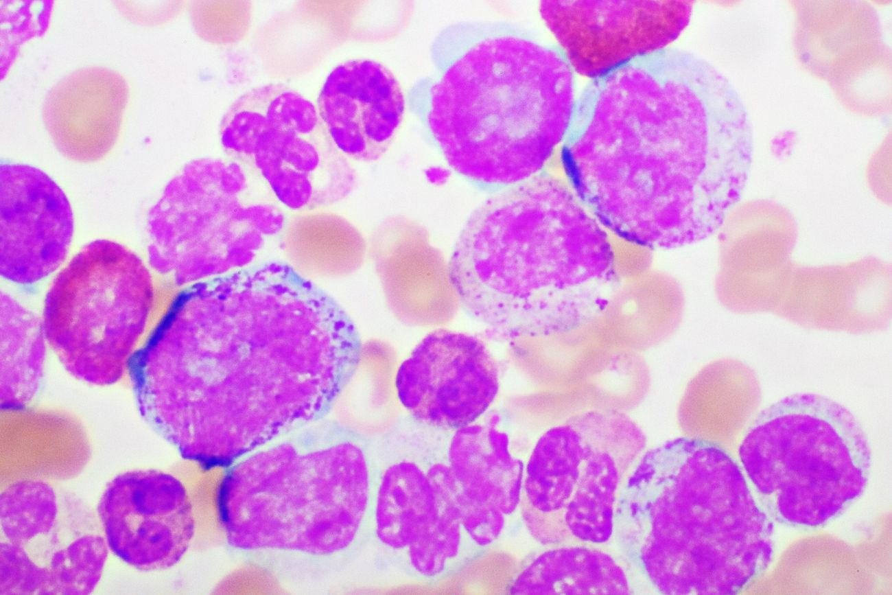 chronic leukemia is often detected by routine blood tests before symptoms appear. getty