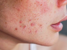 acne on woman's face with rash skin ,scar and spot that allergic to cosmetics
