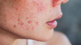 acne on woman's face with rash skin ,scar and spot that allergic to cosmetics