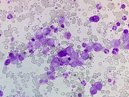 Eessential thrombocytosis blood smear showing abnormal high volume of platelet and White Blood Cell analyze by microscope. Essential thrombocythemia or thrombocytopenia. Microscopic view of slide.