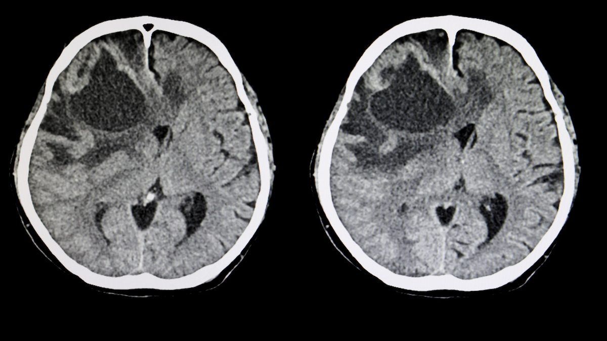 tucatinib is a game-changer in terms of improving overall survival in patients with brain metastases. getty