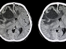 brain metastatic tumor