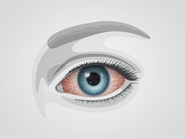 a drawing of an eye that may have pink eye (Conjunctivitis). The photo is in black and white, except for a blue iris and the whit of the eye tinted pink.
