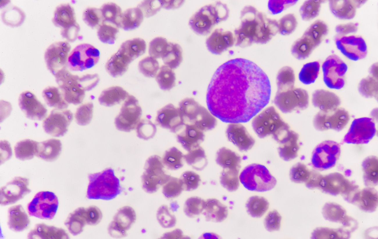 Acute myeloid leukemia is a cancer of the blood and bone marrow, and the most common type of acute leukemia in adults. GETTY