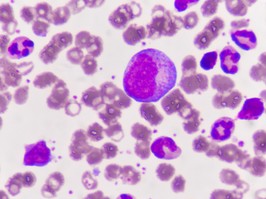 Immature blood cells in leukemia.
