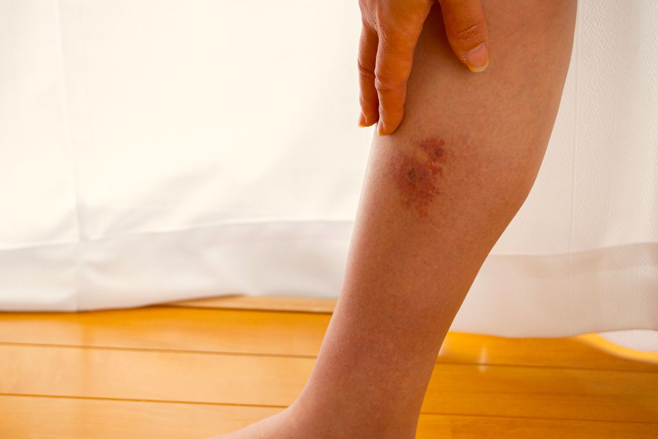 Cellulitis typically appears quickly, in the form of an expanding, red patch of skin that is swollen, warm and painful. GETTY