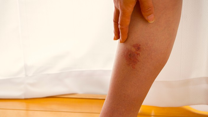 Cellulitis can become life-threatening if not treated