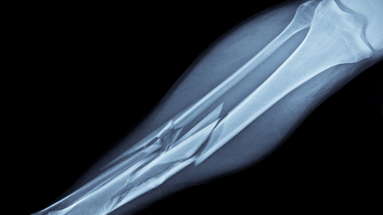 the shin bone, or tibia, is one of two bones in that area of the leg — the other being the fibula. getty