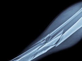 Broken Leg X-Ray