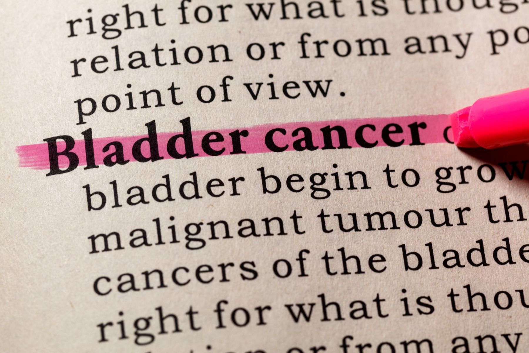 Bladder cancer is the fifth most common cancer in Canada. GETTY