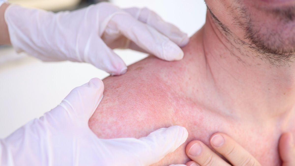 when caught early, the cure rates for melanoma can get as high as 90 per cent, but untreated, melanoma spreads to the bloodstream or lymphatic system, damaging other body parts and causing death. getty