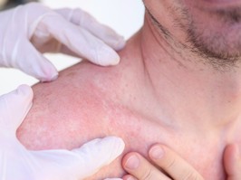 Doctor in gloves conducts initial examination of man with sunburn on skin of his shoulders and back, looking for signs of skin cancer or melanoma