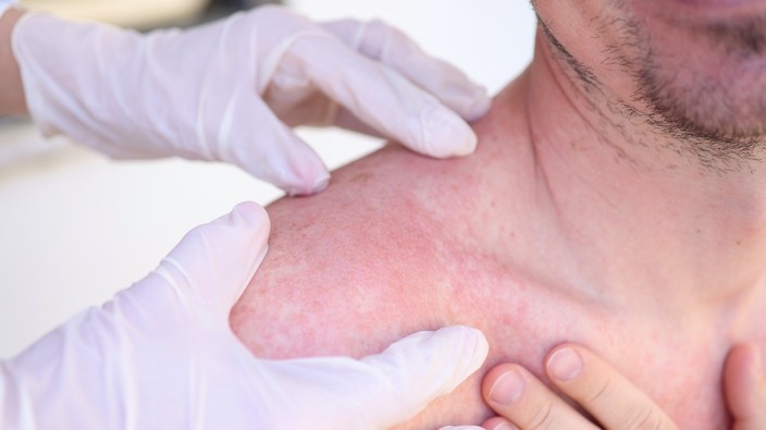 Why does skin cancer — melanoma — spread?