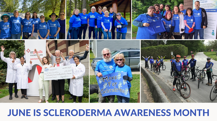 Scleroderma is a rare autoimmune disease
