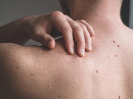 Checking benign moles. Close up detail of the bare skin on a man