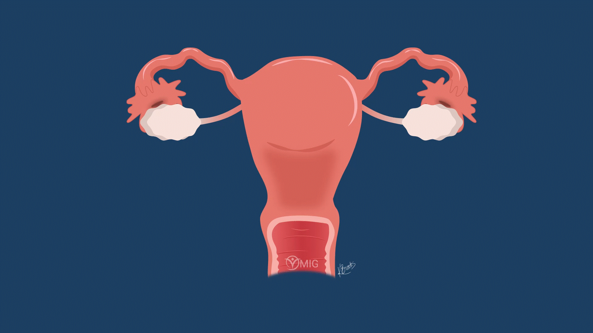 Doctor's Orders How to treat endometriosis Healthing.ca