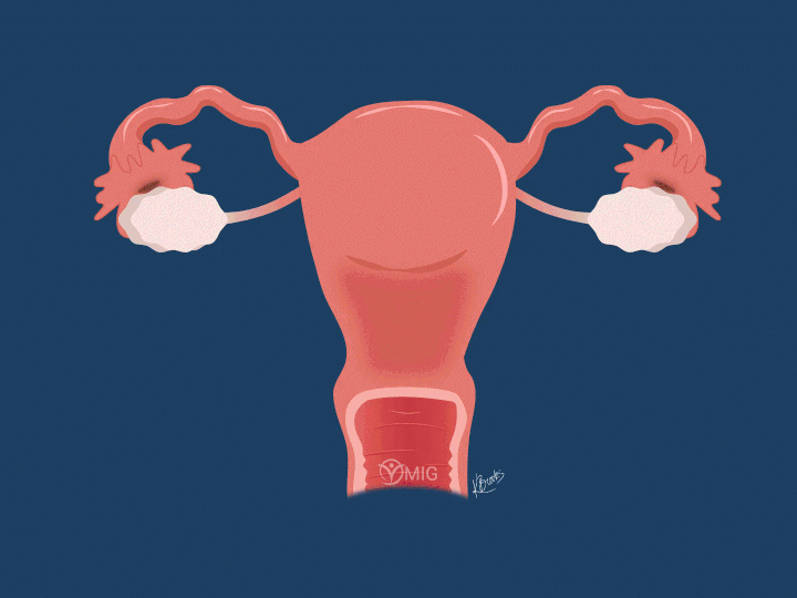 Doctor's Orders: How to treat endometriosis | Healthing.ca