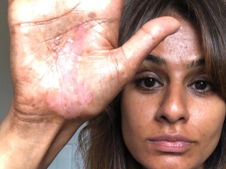  I learned that being vulnerable is like a superpower, and that being vulnerable and open is what really connects me to others,” Reena Ruparelia says of her journey with psoriasis.