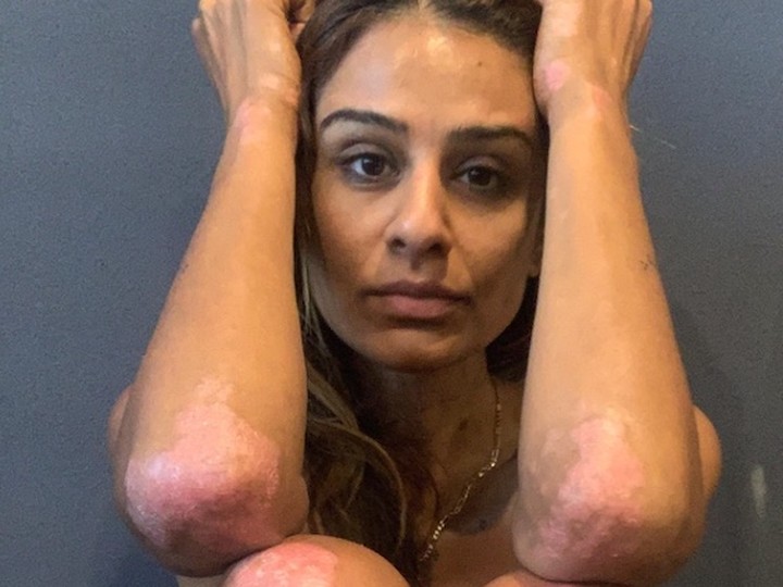  Reena Ruparelia says she doesn’t even remember the feeling of psoriasis when she was diagnosed at 14. “I was much more concerned about how it looked.”