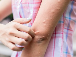 Arm of a girl is bitten by a mosquito putting her at risk of developing West Nile Virus