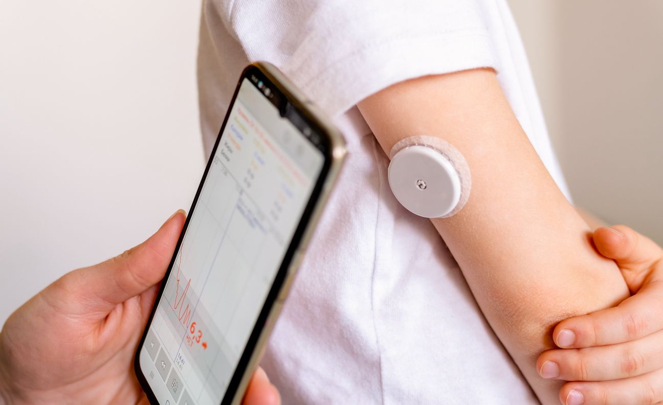 A continuous glucose monitor (CGM) is a wearable sensor and transmitter that tracks blood sugar every few minutes throughout the day and night.