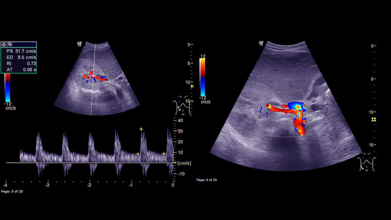 Ultrasound of upper abdomen showing flow in common bile duct after use of colour Doppler.