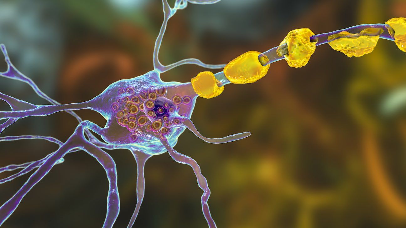 Brain neurons in lysosomal storage diseases, Tay-Sachs, Niemann-Pick, Fabry disease and others.