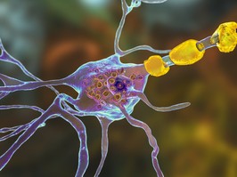 3D illustration showing swollen neurons with lamellar inclusions due to accumulation of gangliosides in lysosomes