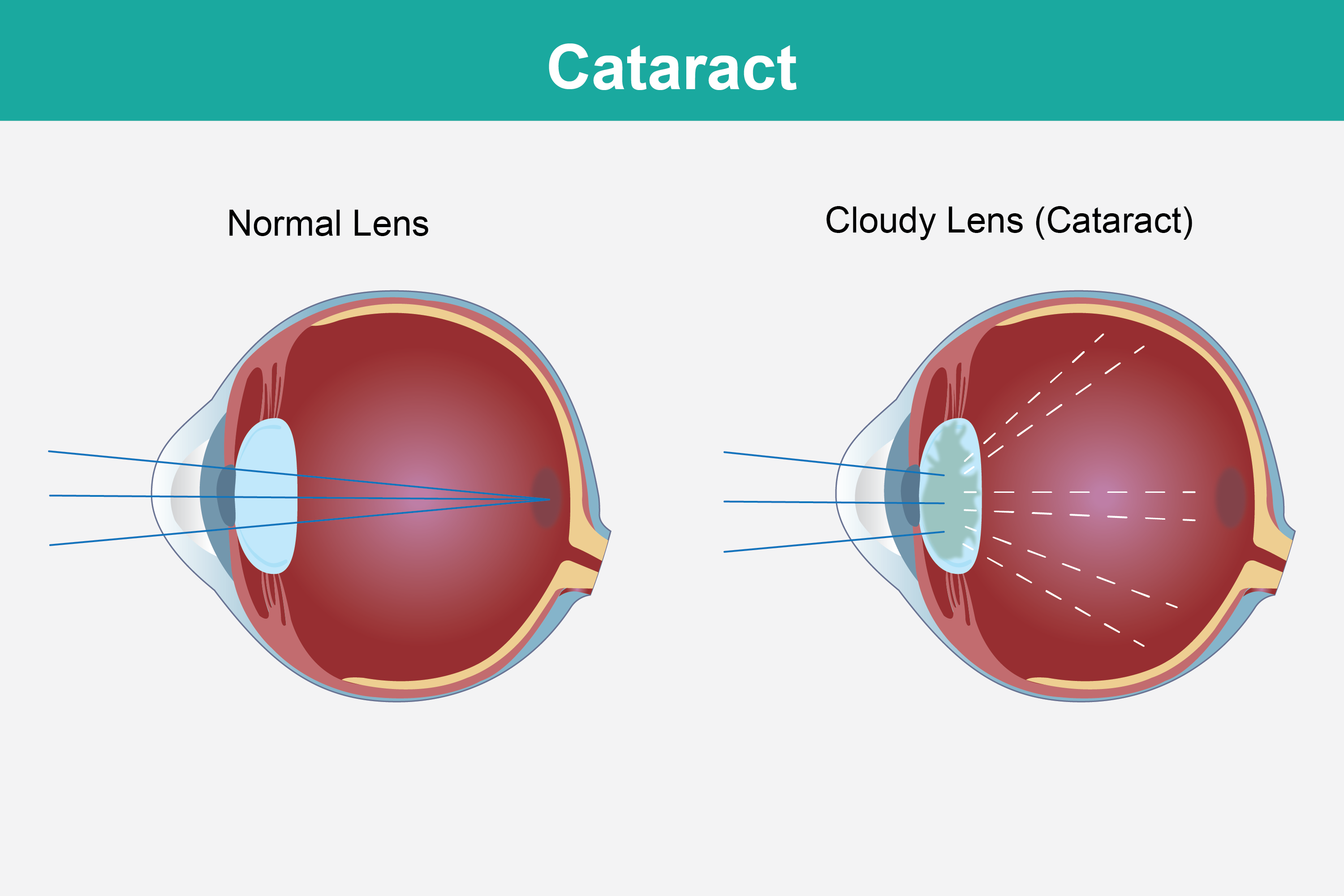 You didn't choose cataracts, but you still have choices Healthing.ca