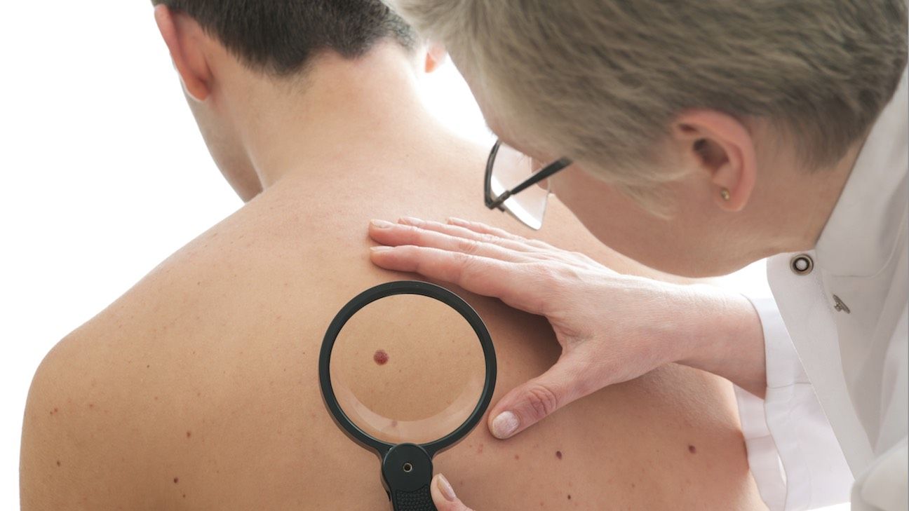 Diagnosed with melanoma: Managing treatments, surveillance, and support 