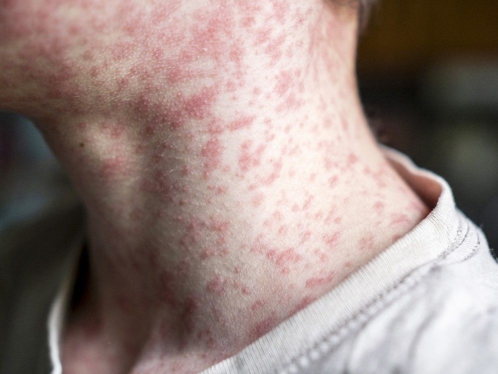 as of may 13, 2025, there are 374 measles cases in total in alberta, bringing the province's case count to the second-highest in the country.