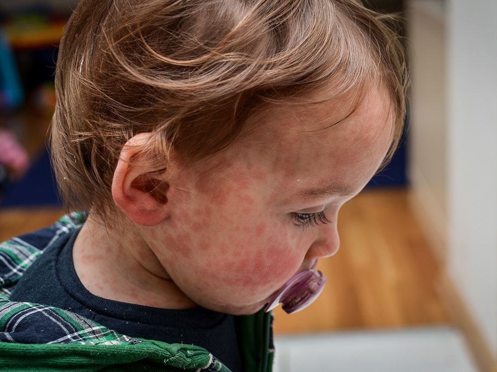 canada hasn't seen close to the current measles numbers since the 752 cases recorded during a quebec outbreak in 2011.