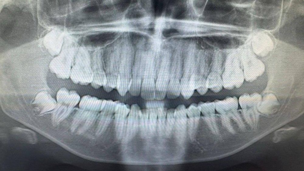 x-ray of persons teeth.