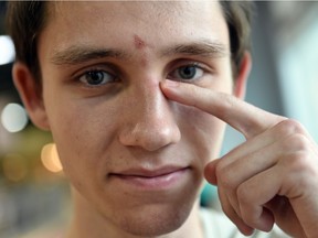 U of Regina cross-country runner Matt Johnson, who sustained a few injuries (including a fractured nose) after falling and getting run over near the start of the CIS championship race Saturday.  Photo taken in Regina, SK on November 16, 2015.