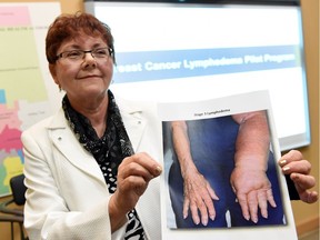 Glenda Cook, a breast cancer survivor, with a photo of a person with lymphedema – a condition caused by accumulation of fluids and proteins between the body's tissues. Lymphedema can develop when lymphatic vessels are damaged or removed as the result of injury, surgery or cancer treatment. Without early diagnosis, treatment and ongoing management, lymphedema is a progressive and irreversible condition that can severely affect a person's quality of life.