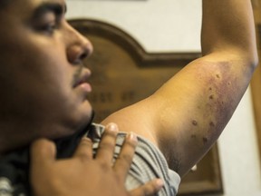Linus Kaysaywaysemat shows the result of a police dog bite he suffered on his arm at his home last Thursday.