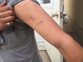 Linus Kaysaywaysemat shows the scars on his left arm while standing on the step where he was bitten by a dog last July.