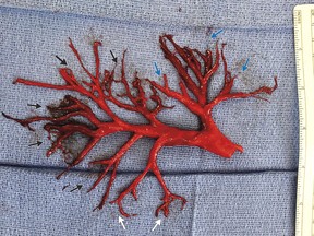 A huge blood clot coughed up by a patient replicates his lung's airways