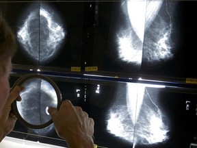 In this May 6, 2010 file photo, a radiologist uses a magnifying glass to check mammograms for breast cancer in Los Angeles. The Canadian Cancer Society says all provinces and territories should lower the starting age for breast cancer screening to 40.