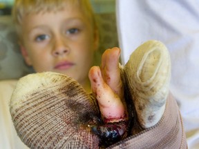 Karter Moschuk of Springford, shows off his soon to be amputated baby finger, that was reattached but wasn't able to be kept viable due to lack of access to leeches according to his father Dave Moschuk. Mike Hensen/The London Free Press)