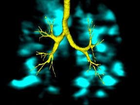 This 2D image shows the lungs of a middle-aged person who was a lifelong tobacco and cannabis smoker. The light blue is the inhaled air and the dark holes are areas where the air isn't going. In vaping patients, oily substances have also been found inside their lung tissue and airways.  (Parraga lab), Author provided