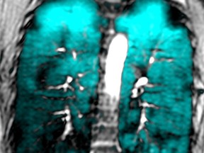 The black wedge shape in the upper right portion of this lung MRI shows an asthma-related defect that's preventing air from reaching the spot. Researchers at Western University have published two studies showing the location of these asthma-related ventilation defects are unique to each patient and do not migrate around the lung over time. (Submitted/Schulich School of Medicine and Dentistry)