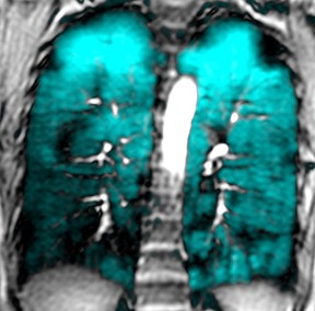 The black wedge shape in the upper right portion of this lung MRI shows an asthma-related defect that's preventing air from reaching the spot. Researchers at Western University have published two studies showing the location of these asthma-related ventilation defects are unique to each patient and do not migrate around the lung over time. (Submitted/Schulich School of Medicine and Dentistry)