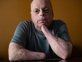 Rick Thompson, who had all of his limbs amputated after contracting bacterial meningitis and septic shock in 2015, poses for a photograph in Coquitlam, B.C., on Monday, March 9, 2020. THE CANADIAN PRESS/Darryl Dyck