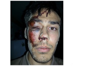 A photo showing the injuries then 23-year-old Joshua Nixon suffered during an interaction with Stratford police on June 27, 2015. Submitted photo