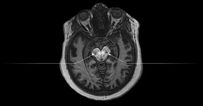 brain scan