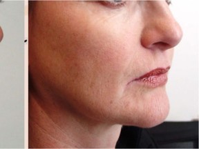 Before and after pictures of a client who underwent PRP treatment (Courtesy of Clarion Medical)